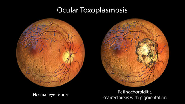 Retinal scar caused by a Toxoplasma gondii infection, or toxoplasmosis, and the same healthy eye retina for comparison, 3D illustration