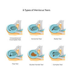 Vector illustration. 6 Types of Meniscus Tears
