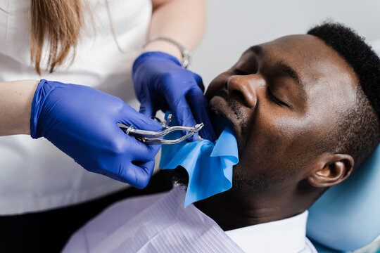 Dentist placing cofferdam in jaw of african man for treatment teeth in stomatology. Dentist using dental dam for tooth isolation.
