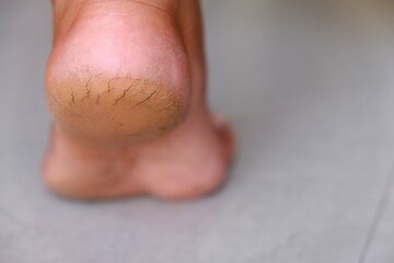 Bear Foot with cracks on Heels