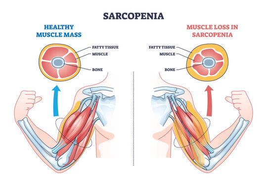 Sarcopenia as muscle mass loss and fatty tissue growth outline diagram. Labeled educational medical scheme with aging caused weakness and muscular pathology vector illustration. Obesity health issue.