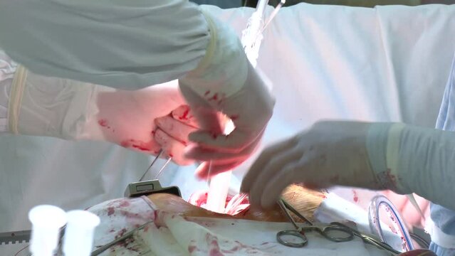 During open heart surgery, if heart valve malfunctions, valve replacement is performed in the operating room to resolve this issue. Doctor doing surgery in modern operating room