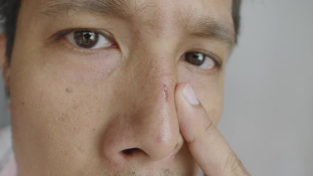 Close-up Asian man with a recent scar in his nose, Problem skincare and health concept.