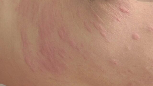 Itchy red blisters on the flanks of men.