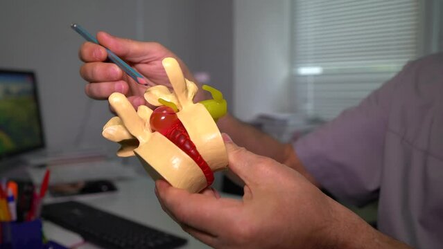 The surgeon shows intervertebral hernia on an artificial model. Rupture of the fibrous ring