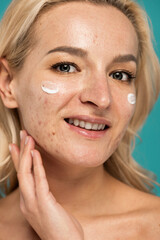 close up of cheerful woman with skin issues applying treatment cream on face isolated on turquoise.