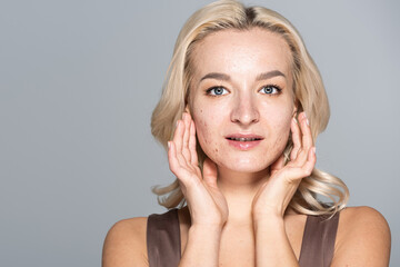 Blonde woman with acne and problem skin touching face isolated on grey.