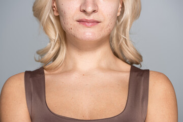 Cropped view of blonde woman with problem skin standing isolated on grey.