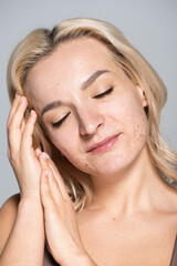Naklejka premium Blonde model with acne on problem skin posing isolated on grey.