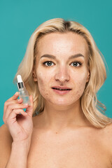 blonde woman with acne on face holding bottle with treatment serum isolated on turquoise.