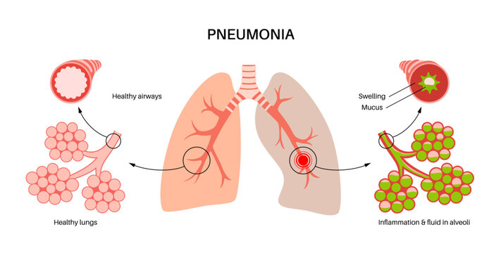 Pneumonia infection poster