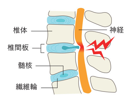 椎間板ヘルニアになった腰椎の説明イラスト