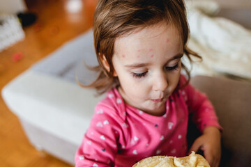 Portrait of little girl with pox. Chickenpox blisters also known as varicella on 2 year old girl head and in hair. Highly contagious skin disease concept. Child with spotted skin. Medical concept