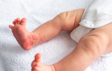 Hemangioma red birthmark on the leg of newborn baby