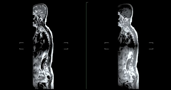 MRI Screening whole spine  for diagnosis  compress spinal cord ( Myelopathy ) .