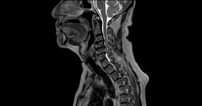 MRI of cervical spine sagittal T2W .