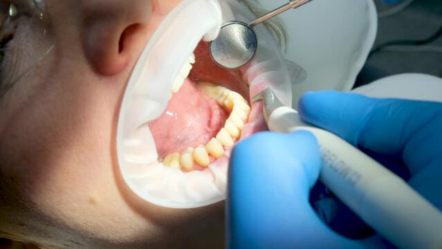 close-up woman dentistry brushing teeth cleaning removing plaque stones saliva ejector using oral mirrors newest technology sandblaster goggles water drops spilling to sides optragate mouth expander