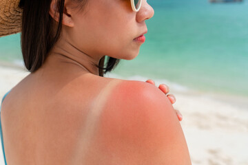 Sunburned skin on shoulder of a woman because of not using cream with sunscreen protection. Red...