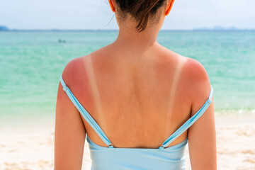Sunburned skin on shoulder and back of a woman because of not using cream with sunscreen protection. Red skin sun burn after Sunbathing at the beach. Summer and holiday concept. Close up - obrazy, fototapety, plakaty