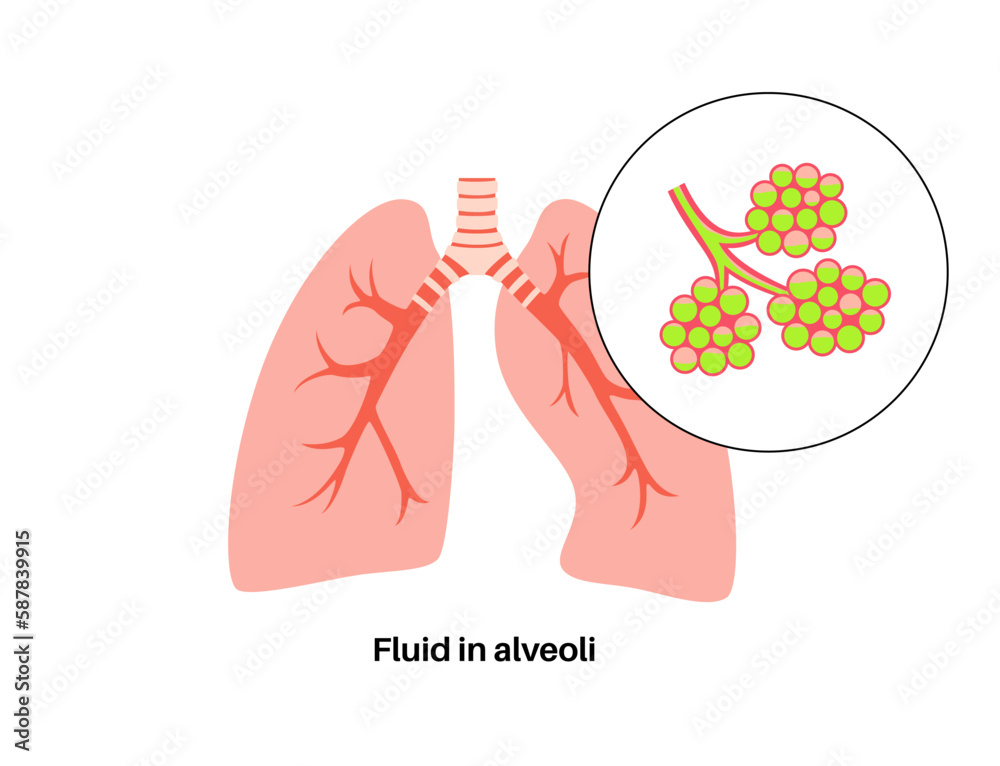 Sticker Pneumonia infection poster