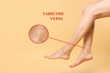 Woman suffering from varicose veins on pastel gold background, closeup. Magnified skin surface...