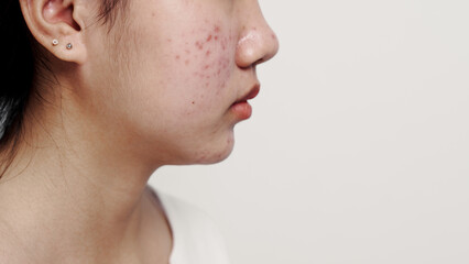 Asian teenage with acne face skin problem, Dermatological disease, white background.