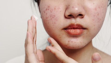 Asian teenage with acne face skin problem, Dermatological disease, white background.