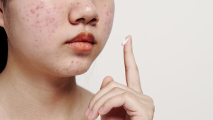 Asian teenage with acne face skin problem, Dermatological disease, white background.