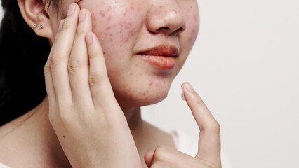 Asian teenage with acne face skin problem, Dermatological disease, white background.