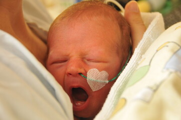 new born baby with a heart patch and a tube in her nose yawns at mummy's breast