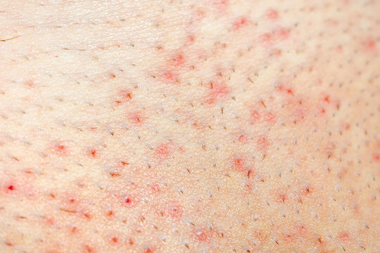 Texture of human skin with many ingrown hairs. Extreme close up macro Skin with keratosis pilaris. 
