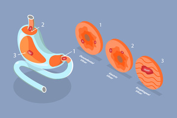 3D Isometric Flat Vector Conceptual Illustration of Peptic Ulcer Stomach Disease, Gastritis and Inflammation