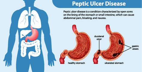 Peptic Ulcer Disease Infographic