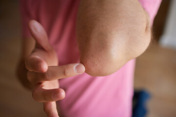 Senior man lubricating with analgetic cream his elbow.