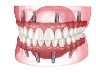 Dental prosthesis based on 4 implants. Dental 3D illustration - 588292109