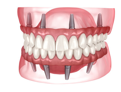 Dental prosthesis based on 4 implants. Dental 3D illustration