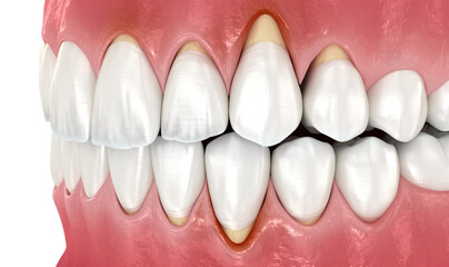 Gingiva recession. 3D illustration of dental disease - 588292370