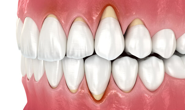Gingiva recession. 3D illustration of dental disease