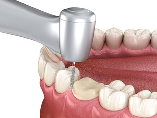 Premolar preparation process for dental crown placement. Dental 3D illustration