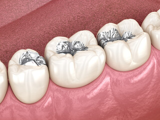 Fototapeta na wymiar Amalgam restoration. Medically accurate 3D animation of dental concept