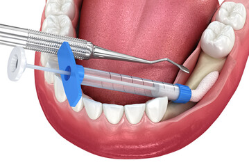 Bone grafting augmentation for tooth implantation. Medically accurate 3D illustration. - 588292913