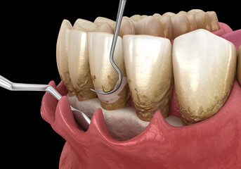 Open curettage: Scaling and root planing (conventional periodontal therapy). 3D illustration