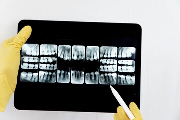 Dentist checking the x-ray on an iPad to indicate his dental treatment to the patient