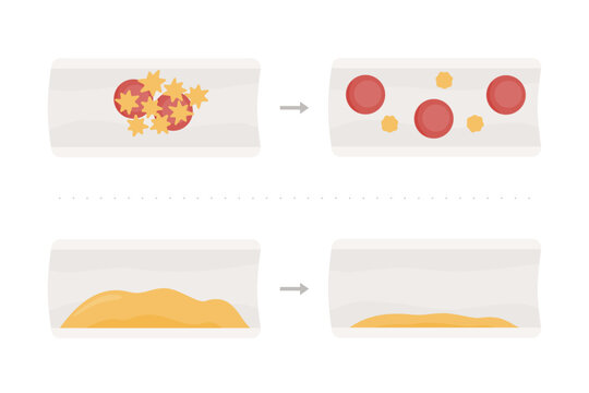 Beneficios Omega 3.  Infograf&iacute;a en arterias y venas. Disminuci&oacute;n de formaci&oacute;n de co&aacute;gulo, trombosis y agregaci&oacute;n plaquetaria, plaquetas. Reducci&oacute;n de grasa, placa de colesterol LDL y triglic&eacute;ridos