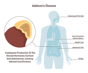 Addison's disease. Symptoms of chronic adrenal insufficiency or hypocortisolism