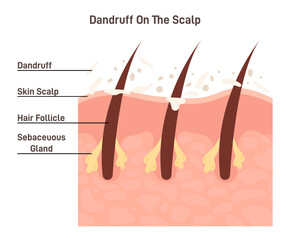 Dandruff. Skin flakes on itchy and dry scalp. Cross section of skin