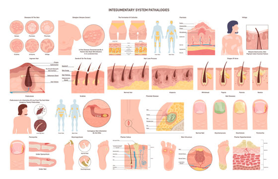 Integumentary system pathologies set. Skin, glands, hair and nail disorders