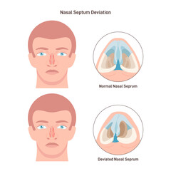 Deviated and normal nasal septum. Medical condition of crooked