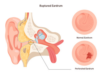Ruptured eardrum. Anatomy of the human ear. Healthy and perforated