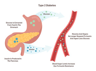 Type 2 diabetes medical vector illustration with english description